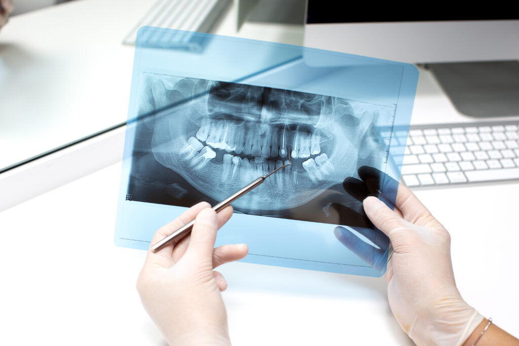 pérdida de hueso dental