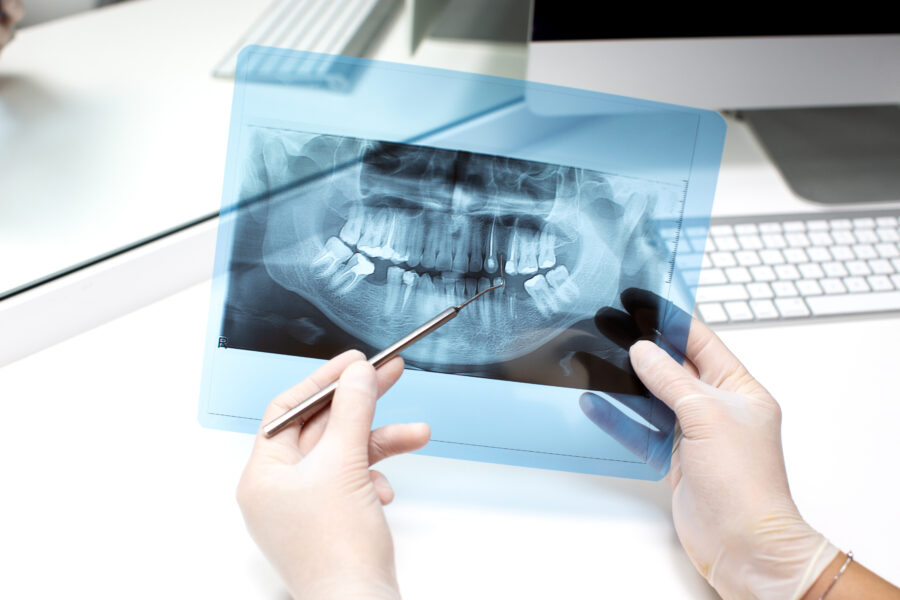 pérdida de hueso dental