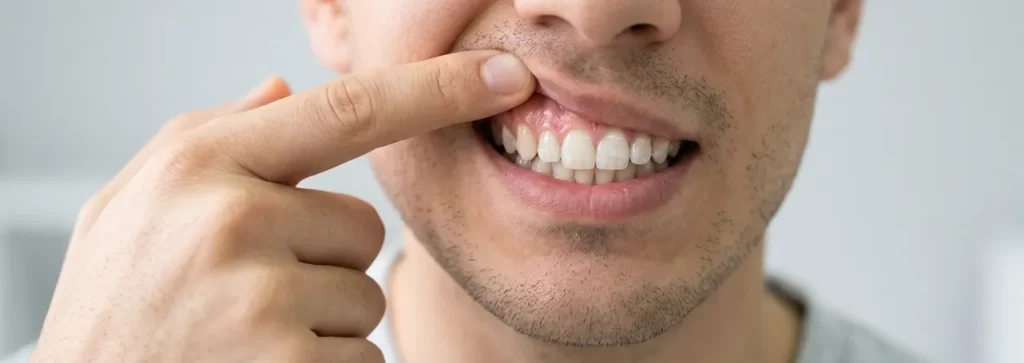 Periodontitis