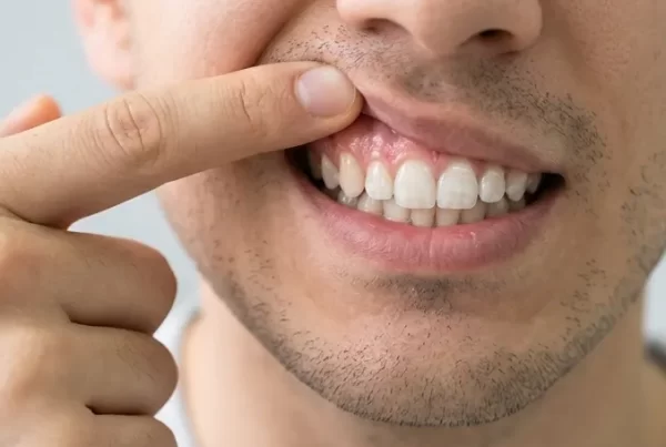 Periodontitis